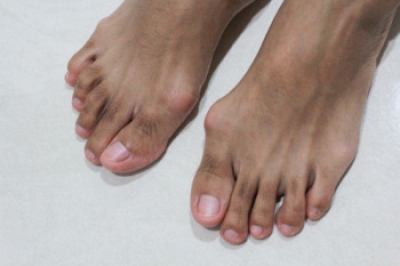 Causes and Symptoms of Bunions