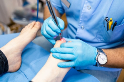 Pros and Cons of Laser Toenail Fungus Removal