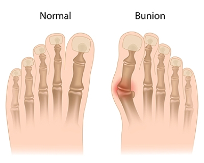 Why Your Feet Rebels With Bunions